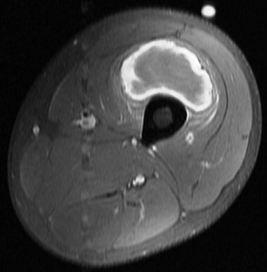 Figure 4 for case vastus intermedius intramuscular hematoma ( RID2702 )